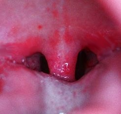 throat chlamydia pictures
