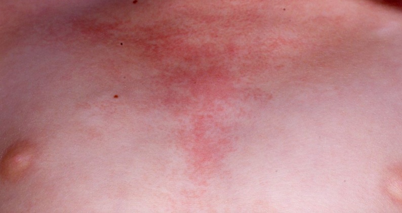 Causes of Shoulder rash - RightDiagnosis.com