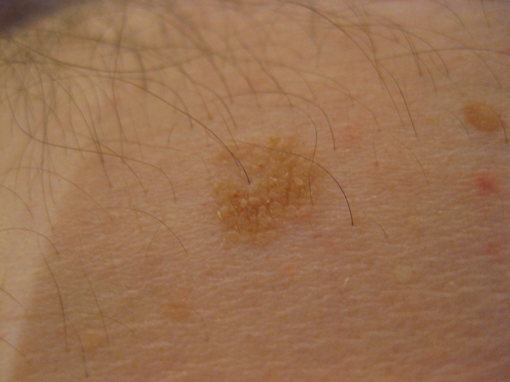 skin spots on chest - MedHelp